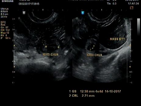 Thai ngoài tử cung là những trường hợp thai không nằm trong lòng tử cung mà nằm ở những nơi khác bên ngoài tử cung, thường gặp nhất là ở vòi trứng, khi vỡ chảy máu ồ ạt vào ổ bụng, đe dọa đến tính mạng, sức khoẻ của người có thai ngoài tử cung vỡ.